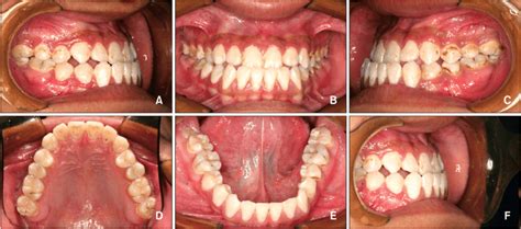 Pretreatment Intraoral Photographs A Lateral View On The Right Side