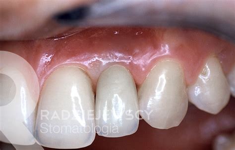 Metamorfozy Stomatologia Radziejewscy Ortodoncja I Nak Adki Invisalign