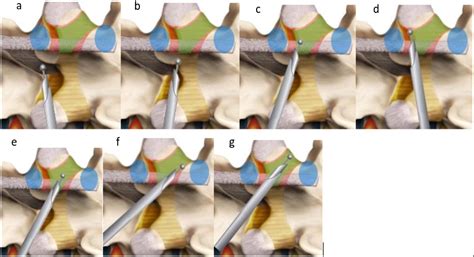 How I Do It Uniportal Full Endoscopic Contralateral Approach For