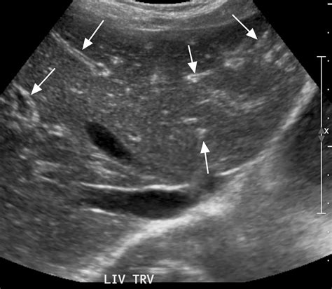 Manifestations Of Sickle Cell Disorder At Abdominal And Pelvic Imaging