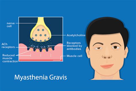 myasthenia gravis meme kung nakakaramdam ng grabeng panghihina
