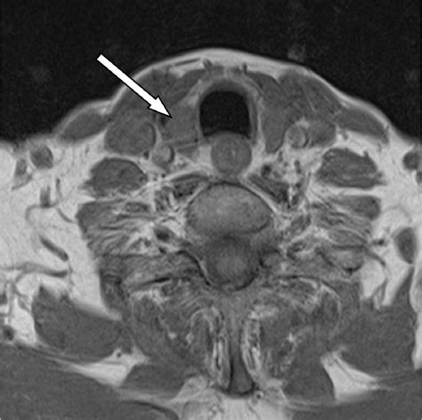 Figure 3 from Diagnostic imaging of the thyroid gland ? CT and MRI ...