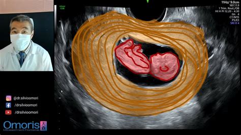 SANGRAMENTO No Primeiro Trimestre Gravidez 10 Semanas Imagens Em 3D