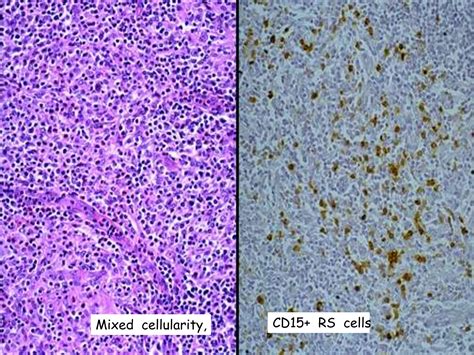 Hodgkin Lymphoma Definition Pathogenesis And Pathology Ppt