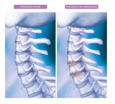 Rayos X De La Osteoartritis