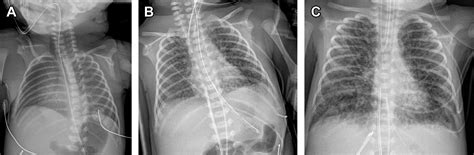 Respiratory Distress In Neonates Radiologic Clinics