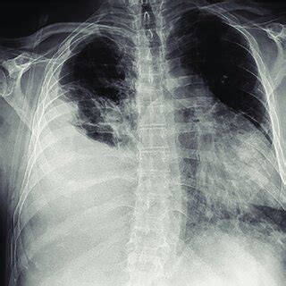 SVC syndrome. SVC, superior vena cava. | Download Scientific Diagram