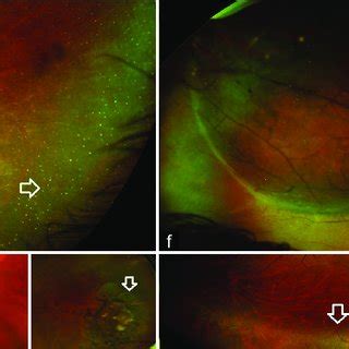 Pictures Of Typical Peripheral Retinal Lesions Seen On Optomap Images