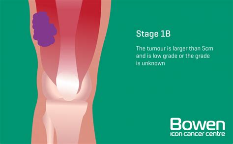 What Is Soft Tissue Sarcoma Soft Tissue Sarcoma Explained — Bowen Icon