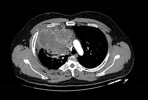 Mediastinal germ cell tumor - wikidoc