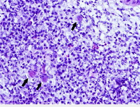 Specimen From Colon Biopsy With Hematoxylin And Eosin Stain 400x The Download Scientific