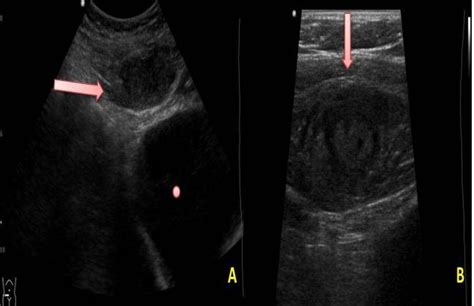 A Pelvic Ultrasound That Shows An Heterogeneous Collection Red