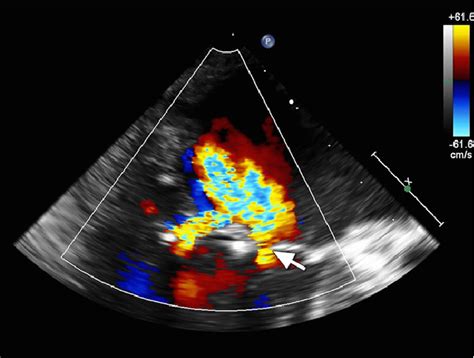 Transesophageal Echocardiogram In Color Flow Doppler Mode Shows