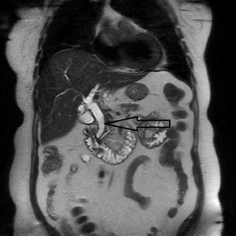 Mrcp Common Biliary Duct Dilatation Mrcp Magnetic Resonance