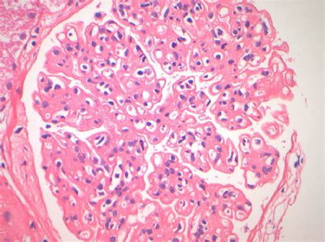 A Membranoproliferative Glomerulonephritis In A Hcv Infected Patient Download Scientific