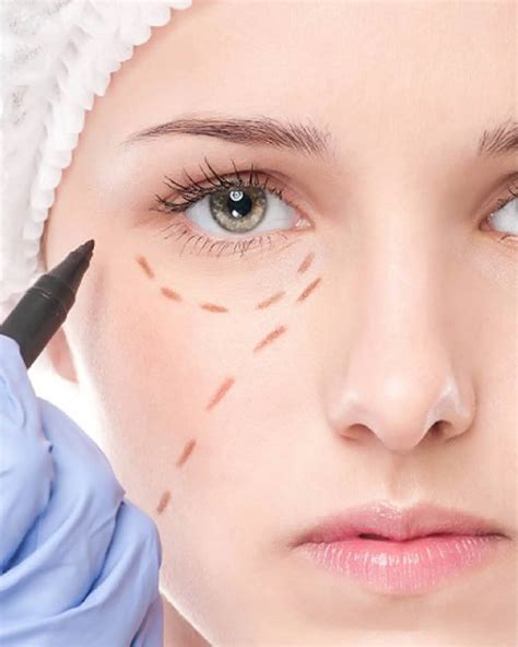 eye bags under eyes 14
