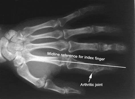 Finger Arthritis