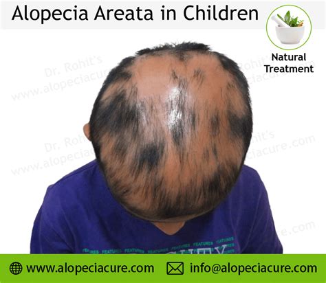 Alopecia areata in children