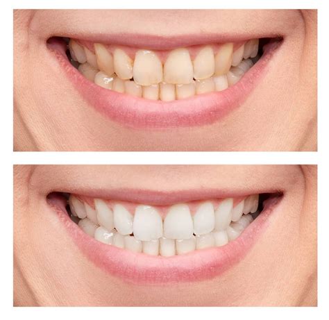 Teeth Whitening In Turkey As An Alternative To Dental Veneers