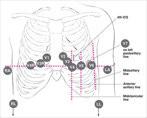 Ekg Placement