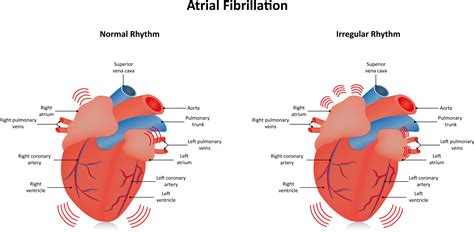 AFib - Sleep Apnea And Its Effect On The Body