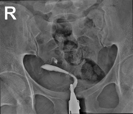 Unicornuate Uterus Radiology Case Radiopaedia Org