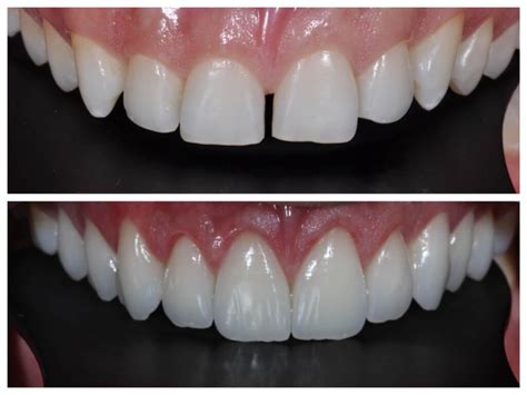 Diastema O Que é Como Fechar E Tipos De Tratamento