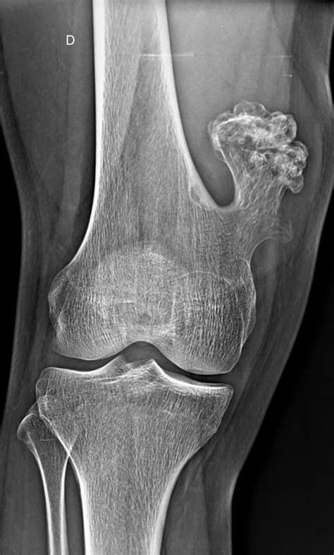 Osteochondroma Distal Femur Image Radiopaedia Org