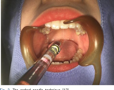 Mandibular Third Molar