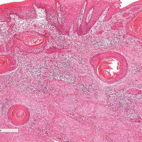 Case 2 Squamous Cell Carcinoma With Basaloid Features Demarcated By A