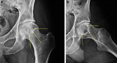 A Preoperative Anteroposterior Ap Radiograph Demonstrating Femoral Download Scientific