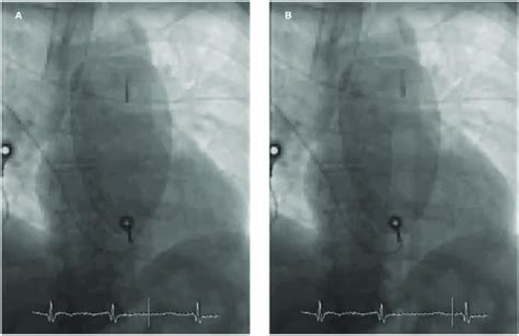 Intra Aortic Balloon Pump Placement A Intra Aortic Balloon Pump