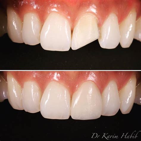 Composite Veneers Sydney Dental Bonding Sydney Dentist Ryde