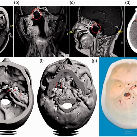 Cranial Contrast Enhanced Magnetic Resonance Imaging Mri Showed Download Scientific Diagram