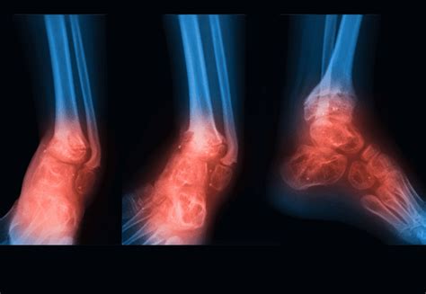 Osteomyelitis Causes Symptoms And Treatment Essential Health Reports