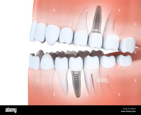 Human Teeth And 3d Hi Res Stock Photography And Images Alamy