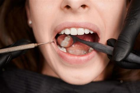 How To Care For Your Mouth Following Wisdom Tooth Surgery For Faster Healing Clear Choice Dental