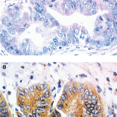 Representative Ihc Staining For Her 2neu In Pancreatic Tumours A