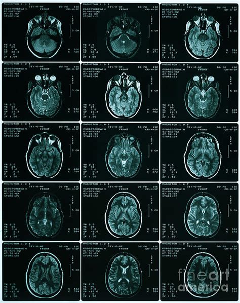 Mri Of Normal Brain Photograph By Science Source Pixels