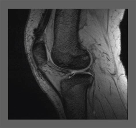 Knee MRI scan - Sanjay Gupta