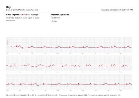 Hands on with Apple Watch's ECG and irregular heart rhythm features ...