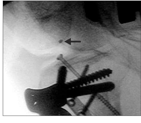 Figure 1 From Separation Of The Tip Of A Coblation Wand Within The Knee