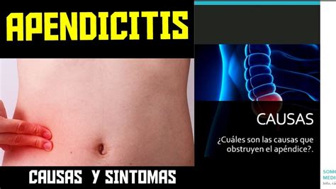 Que Es La Apendicitis Cuales Son Las Causas Y Síntomas Youtube