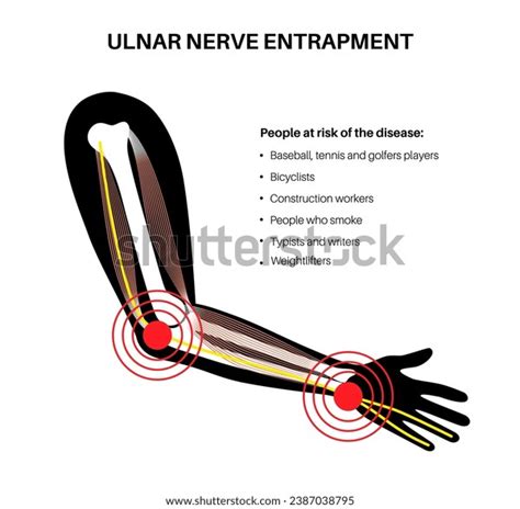 Ulnar Nerve Entrapment Cubital Tunnel Syndrome Stock Vector Royalty