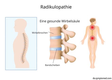 Radikulopathie Symptome