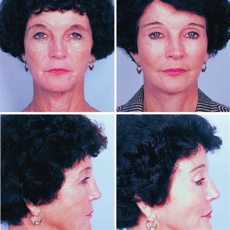 Pdf Rejuvenation Of The Midface By Elevating The Malar Fat Pad