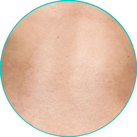 VISIBLE: Moderate to Severe Plaque Psoriasis Skin Results | TREMFYA ...