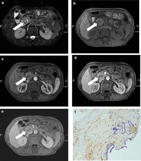 A 68 Year Old Male With Pdac Of The Pancreatic Head Ae Arrow