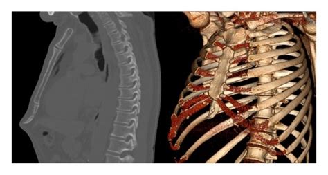 Computerized Tomography Of Xiphoid Process Protrusion Download