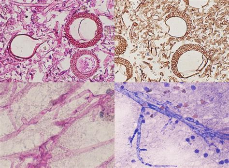 Pathology Of Gangrene Intechopen